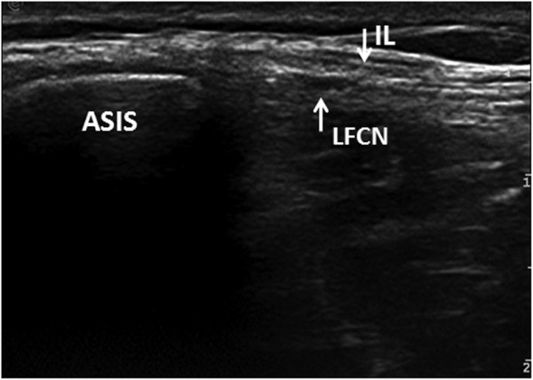 Transverse ultrasound showing the lateral femoral cutaneous nerve passing directly through the inguinal ligament near the anterior superior iliac spine, an anatomical course predisposing to compression.