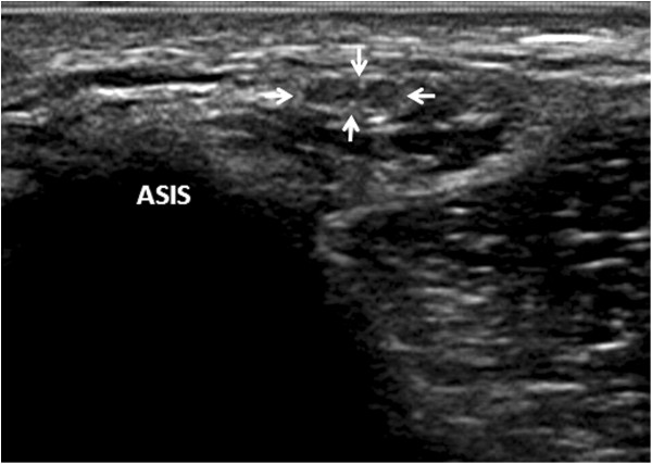 Transverse ultrasound near the anterior superior iliac spine showing a neuroma of the lateral femoral cutaneous nerve, indicated by the arrow.
