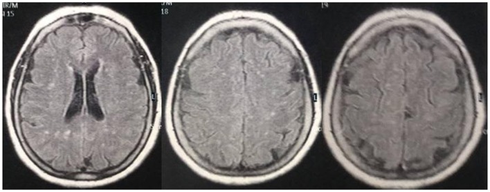 Axial brain MRI in a patient with a long history of migraine, showing white matter abnormalities frequently found in people with migraine.