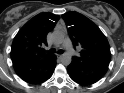 Axial chest CT: symmetrical thymic hyperplasia in a patient with myasthenia gravis, arrows on the enlarged gland.