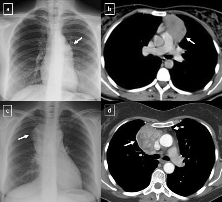 Chest radiograph and CT: stage II then stage III thymoma in two patients with myasthenia gravis, arrows on the anterior mediastinal mass.