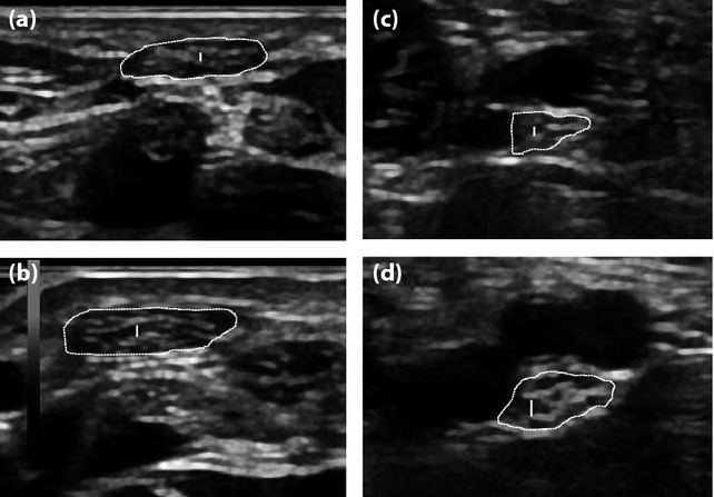 Échographie haute résolution en coupe transversale : nerf médian d'un sujet témoin (a) et d'un patient diabétique de type 2 (b), nerf tibial postérieur d'un témoin (c) et d'un diabétique (d), section du nerf détourée.