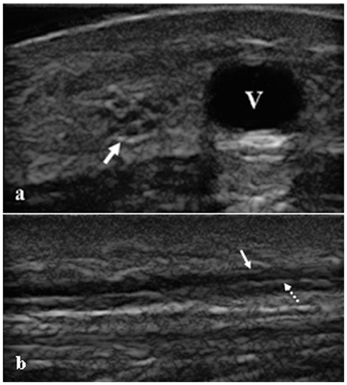 Échographie du nerf sural en coupe transversale (a) et longitudinale (b), flèches sur le nerf, technique d'évaluation de la neuropathie cutanée diabétique.