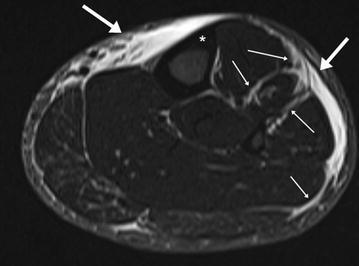 IRM axiale de jambe, séquence STIR : épaississement et hypersignal du fascia et des cloisons intermusculaires sans réaction périostée du tibia, tableau de périostite tibiale (shin splint) sévère chez un coureur d'ultra-fond.