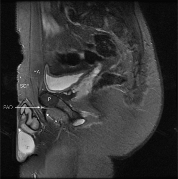 Sagittal MRI of the groin with anatomical landmarks: pubic aponeurosis defect (PAD) at the junction of the rectus abdominis and adductor tendon, a lesion typical of athletic pubalgia.