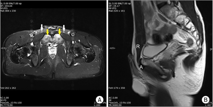 MRI of the pubic symphysis in two slices, fat-saturated T2 sequences: bilateral and symmetric bone marrow oedema of both sides of the symphysis, yellow arrows, most pronounced anteroinferiorly.
