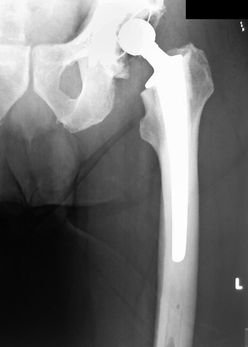 Anteroposterior radiograph of the left hip: total hip replacement in place five days after surgery, with the femoral stem and acetabular cup visible.