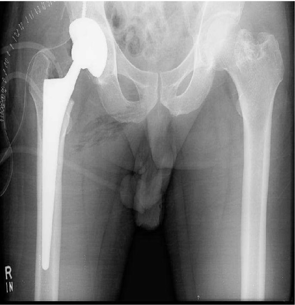 Anteroposterior pelvic radiograph: total hip replacement in place on one side, with the native contralateral hip visible for comparison.