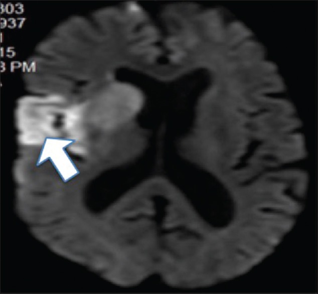 IRM cérébrale en diffusion, coupe axiale : infarctus sylvien droit précoce, hypersignal étendu signalé par une flèche.