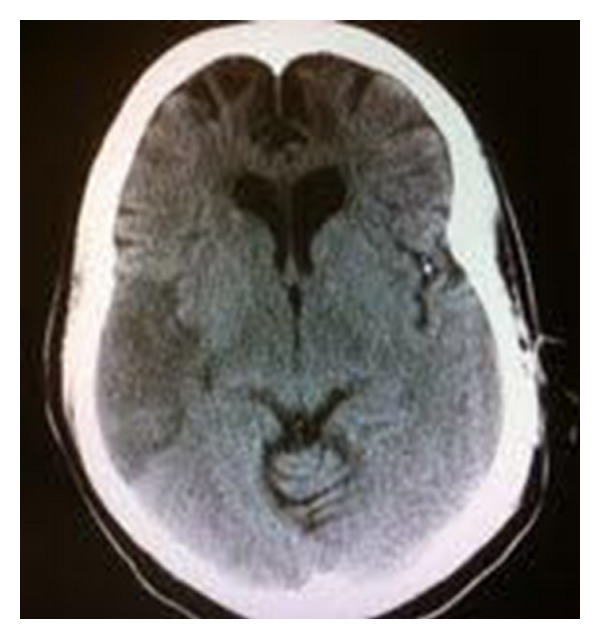 Scanner cérébral sans injection, coupe axiale : infarctus sylvien droit étendu, perte de la différenciation substance grise-substance blanche de l'hémisphère droit.