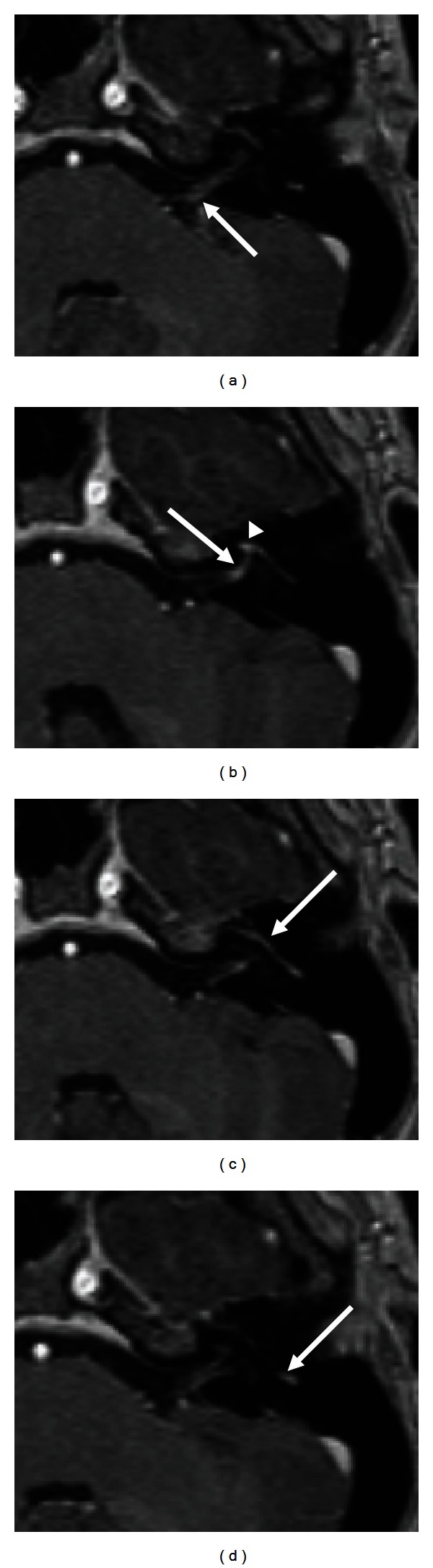 T1-weighted MRI after gadolinium injection: abnormal enhancement of the facial nerve along its course, arrows, in Bell's palsy.