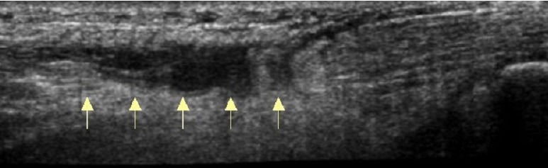 Sagittal ultrasound of the Achilles tendon: rupture of the middle third of the tendon, arrows beneath the discontinuity.