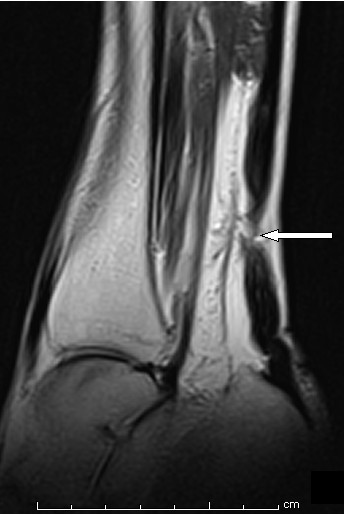 Sagittal ankle MRI: rupture of the Achilles tendon, arrow on the area of fibre discontinuity.