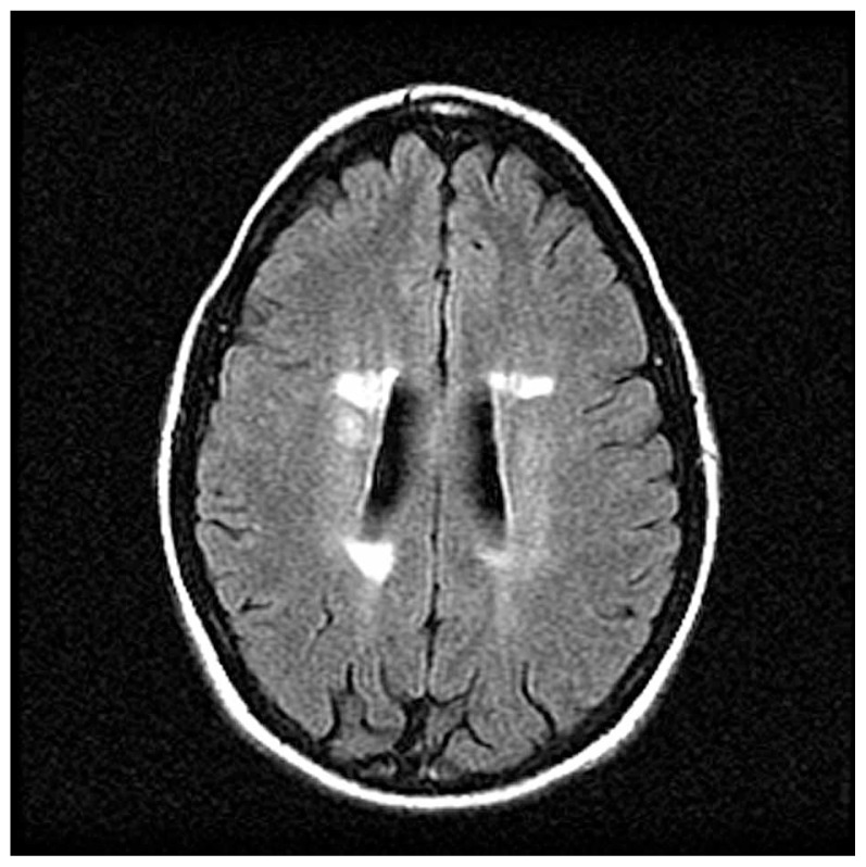 Axial FLAIR brain MRI: hyperintense periventricular lesions typical of demyelination in multiple sclerosis.