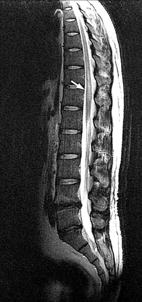 Sagittal T2 spinal MRI: high-signal lesion of the lower thoracic spinal cord, arrow on the lesion, typical of spinal cord involvement in multiple sclerosis.