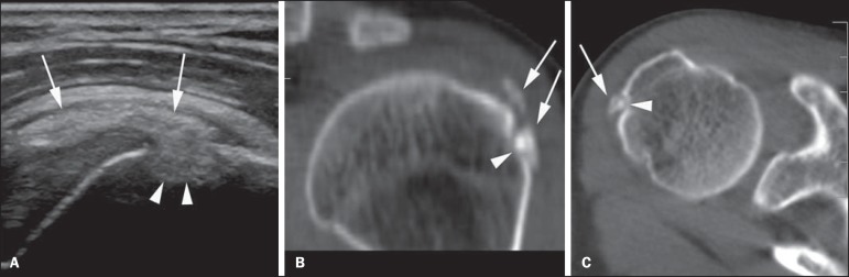 Échographie puis scanner de l'épaule : calcification intratendineuse de l'infra-épineux avec érosion osseuse corticale adjacente, flèches sur le dépôt calcique et la migration intra-osseuse.