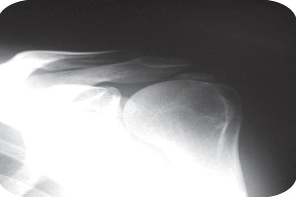 Radiographie de face de l'épaule gauche : calcification en regard du tendon du supra-épineux, au-dessus de la tête humérale, signe radiographique classique de la tendinopathie calcifiante.