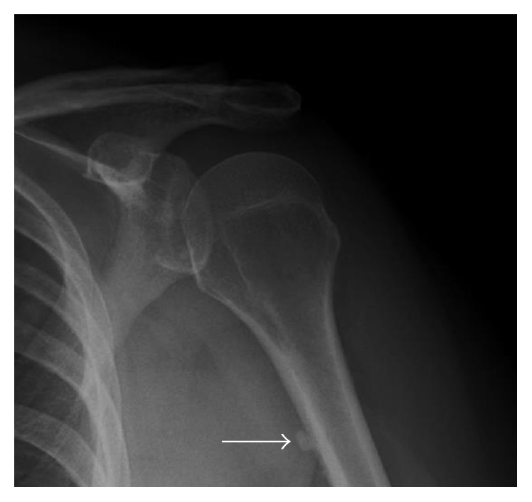 Radiographie de l'épaule de face : calcification linéaire le long de la corticale antérieure de la diaphyse humérale, flèche, tendinopathie calcifiante du grand pectoral.