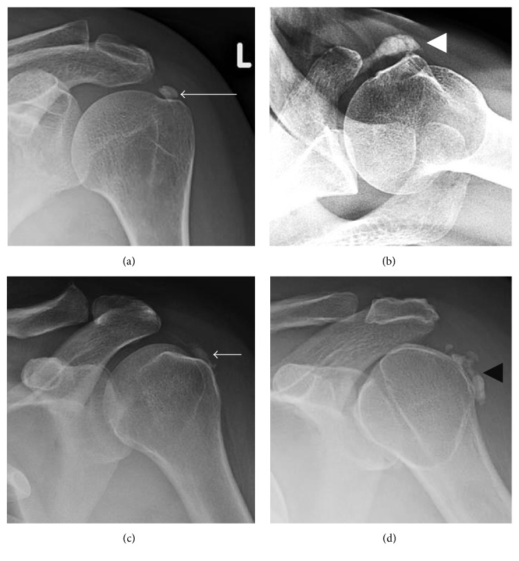 Radiographies d'épaule sous quatre incidences : dépôts calciques au sein des tendons de la coiffe des rotateurs, flèches sur les calcifications du supra-épineux, du subscapulaire, de l'infra-épineux et du petit rond, caractéristiques d'une tendinopathie calcifiante.