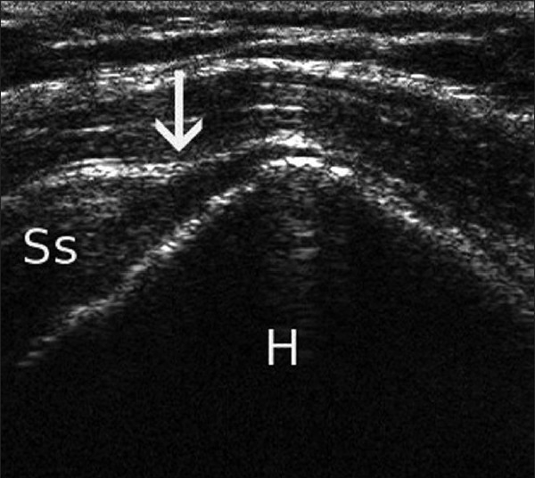 Échographie d'épaule : déchirure transfixiante du tendon du supra-épineux, flèche sur la solution de continuité au-dessus de la tête humérale.