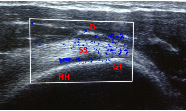 Échographie Doppler puissance d'épaule chez un sportif : néovascularisation intratendineuse au niveau du tendon du supra-épineux, signe échographique caractéristique de la tendinopathie.