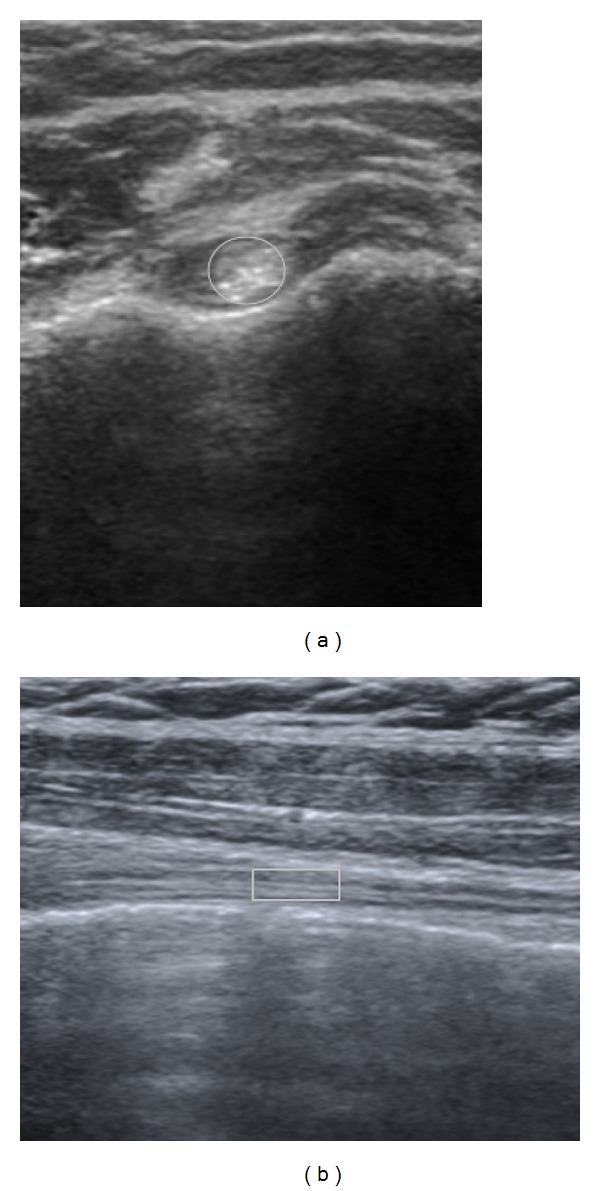 Échographie du tendon du long biceps en coupes transversale et longitudinale : hypoéchogénicité autour du tendon, zone de mesure entourée, tendinopathie.