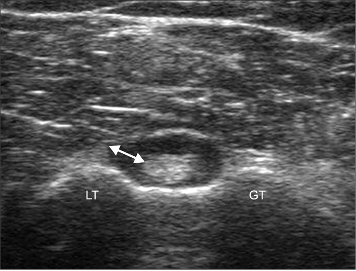 Échographie du tendon du long biceps en coupe transversale au sillon bicipital : épanchement dans la gaine tendineuse, flèche sur la distance mesurée.