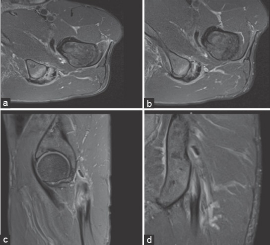 IRM de cuisse en coupes axiale et coronale : épaississement hétérogène du tendon proximal commun des ischio-jambiers avec rupture partielle et œdème osseux de la tubérosité ischiatique.