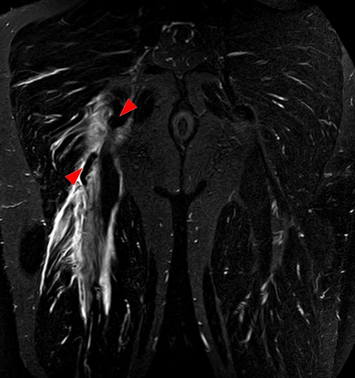 IRM de bassin en coupe coronale, séquence STIR : rupture des tendons des ischio-jambiers à leur insertion sur la tubérosité ischiatique, avec moignon tendineux rétracté (têtes de flèches).