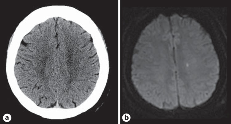 Brain CT and MRI performed on the same day in a patient with a TIA: normal CT, but a very small area of restricted diffusion visible on diffusion-weighted MRI.