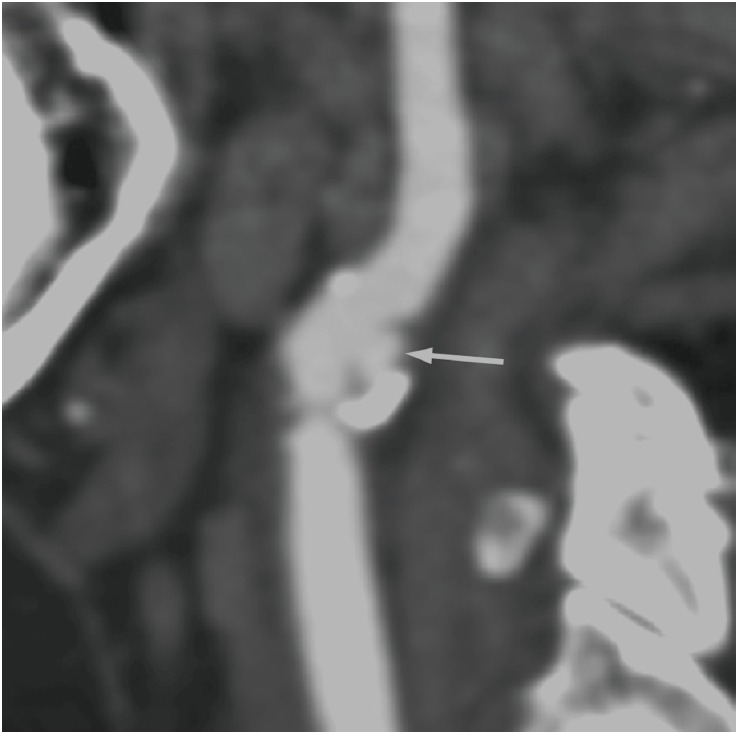 Cervical CT angiography: ulcerated, calcified carotid plaque, arrow on the plaque, a frequent cause of transient ischaemic attack.