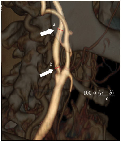 3D volume-rendered CT angiography of the carotid artery: measurement of the degree of internal carotid artery stenosis, arrows on the point of maximal stenosis and on a healthy reference segment.