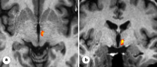 Functional MRI in axial and coronal planes: activation of the posterior hypothalamus on the side of the pain, the result of a group analysis in patients with episodic cluster headache.