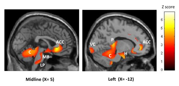 FDG-PET in sagittal sections: areas of cerebral hypermetabolism, including the hypothalamus, in patients with chronic cluster headache.