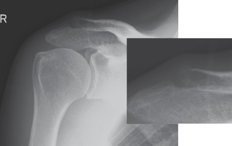 Shoulder radiograph with magnified view: osteosclerosis of the distal clavicle and a subchondral cyst, signs of acromioclavicular osteoarthritis.