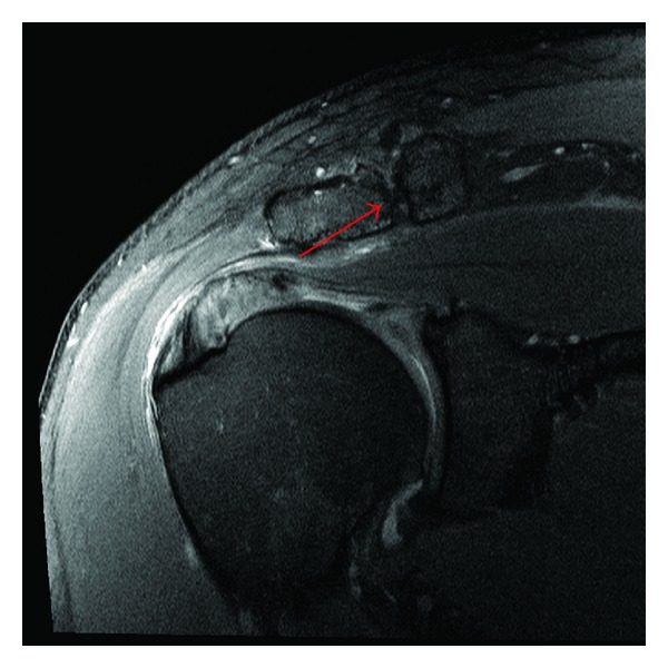 Coronal shoulder MRI, fat-suppressed PD sequence: moderate to severe osteoarthritis of the acromioclavicular joint, arrow on the joint.