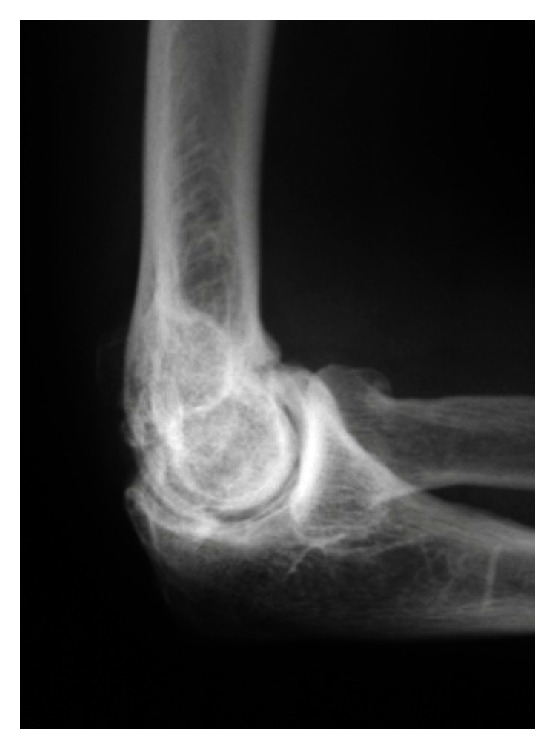 Lateral elbow radiograph: osteophytes on the radial head and on the anterior and posterior aspects of the ulnohumeral joint, typical signs of elbow osteoarthritis.