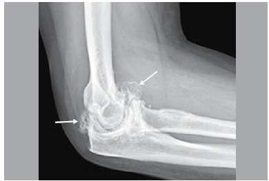 Elbow radiograph at an advanced stage of osteoarthritis: destruction of the articular surface and intra-articular loose bodies, arrows, corresponding to the most severe radiographic grade.