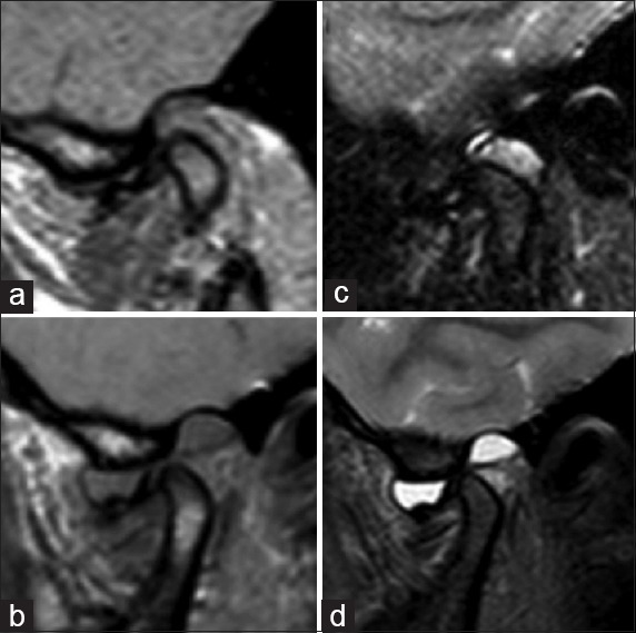 Sagittal open-mouth MRI of the temporomandibular joint: anterior disc displacement without reduction, before (a, b) and after treatment (c, d).