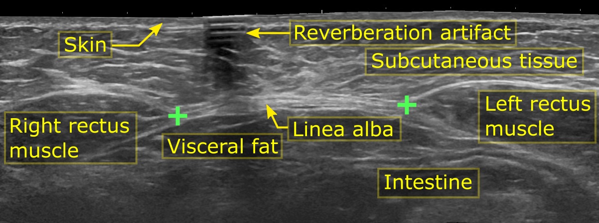 Annotated axial abdominal ultrasound, between the xiphoid process and the navel: distance of 3.5 cm between the rectus abdominis muscles on either side of the linea alba, without associated hernia.
