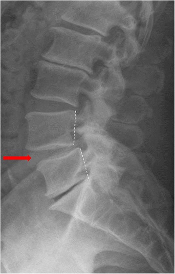 Radiographie de rachis lombaire de profil, debout : spondylolisthésis dégénératif L4-L5, flèche et repères pointillés montrant le glissement antérieur de L4 sur L5.