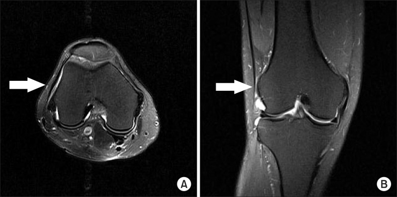 Axial and coronal knee MRI: fluid collection and increased signal adjacent to the iliotibial band, at the level of the lateral femoral epicondyle, supporting arrows.