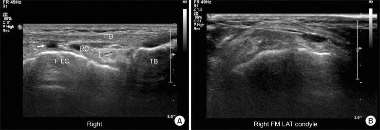 Ultrasound of the iliotibial band at the lateral femoral epicondyle: local fluid collection visible beneath the band, with ultrasound-guided needle localisation.