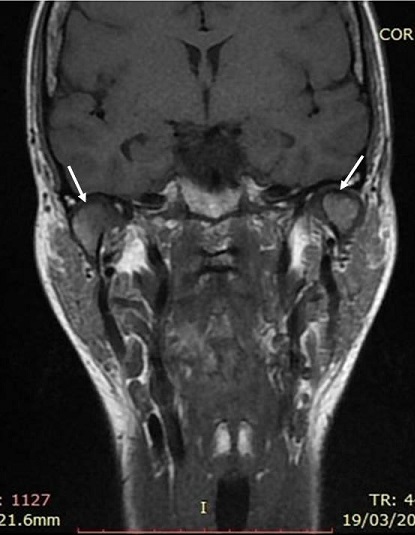 IRM de l'articulation temporo-mandibulaire en coupe coronale : géodes sous-chondrales bilatérales et amincissement du cortex du condyle mandibulaire (flèches).
