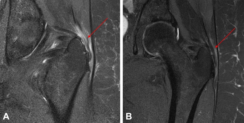 IRM coronale de hanche avant et après traitement : épaississement du tendon du moyen fessier avec hypersignal intratendineux, flèche, réduction visible après injection de ténocytes autologues.