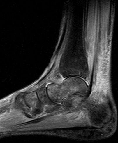 Sagittal STIR MRI of the foot showing skin and subcutaneous oedema associated with diffuse bone marrow oedema of the calcaneus, talus and distal tibia, characteristic of type I CRPS.