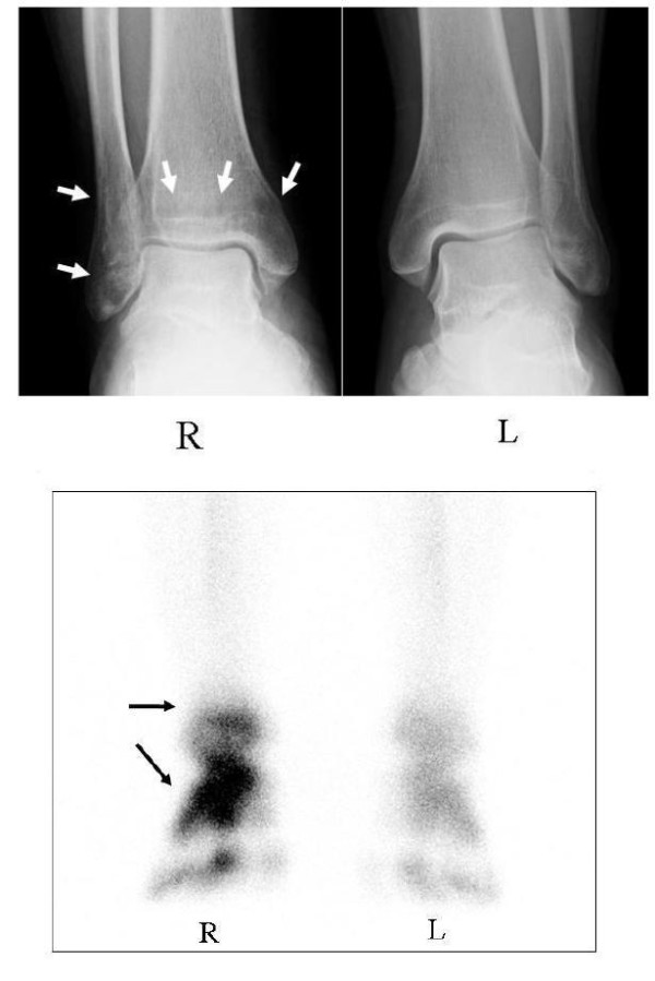Radiograph and bone scintigraphy of both ankles before treatment, showing demineralisation of the right ankle affected by CRPS and marked increased uptake at the same site.