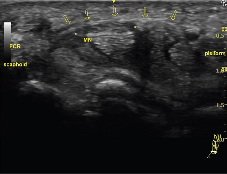 Transverse wrist ultrasound showing a markedly enlarged median nerve within a carpal tunnel with an intact transverse ligament, in a patient with carpal tunnel syndrome.