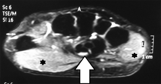 Axial T2-weighted wrist MRI showing hyperintensity of the median nerve as well as oedema of the thenar and hypothenar muscles, in a case of carpal tunnel syndrome.