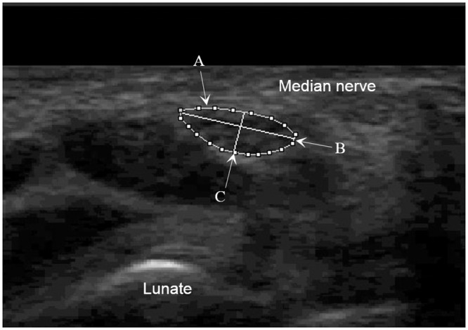 Transverse wrist ultrasound at the level of the wrist crease: outline of the median nerve cross-sectional area, the reference diagnostic method for carpal tunnel syndrome.